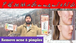 acne cream | pimples kaise hatay | how to treat acne | acne ka elaj | benoxyl cream | benzoyl peroxi