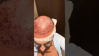 HAIR TRANSPLANT AFTER 6 MONTHS | HAIR TRANSPLANT RESULT