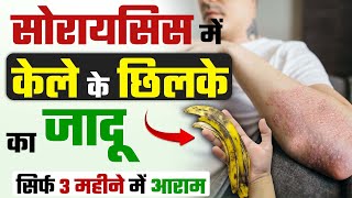 केले के छिलके से करें स्किन सोरायसिस को परमानेंट ठीक | Psoriasis skin disease treatment