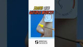 역대급 코성형 부작용 #shorts