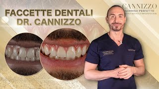 Faccette in Ceramica - Dr. Cannizzo