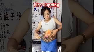 FIRE CUPPING 🔥||#health #alternativemedicine #viral #cuppingtherapy