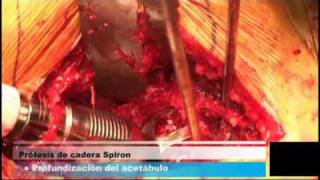 Chirurgie: Spiron OP Mexico  - Part II -