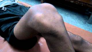 habitual dislocation of patella