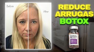 ¿Qué es el BOTOX? REJUVENECE tu CARA en POCO TIEMPO