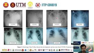 Surviving Critically Severe Covid-19 Infection Case: Clinical Pathology Perspective - Rahmawan