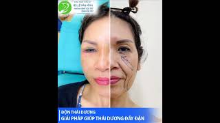 Nên Độn Thái Dương Hay Tiêm Filler - Thẩm Mỹ Khang Vĩnh