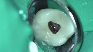 Case2: #3 Root canal treatment through Zirconia crown