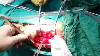 Facia lata flap in maxillofacial ot mmc