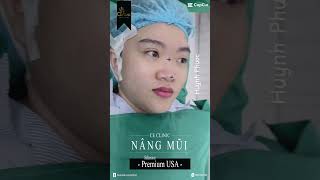 #nangmui #CECLINIC Dáng Mũi Nano Plus