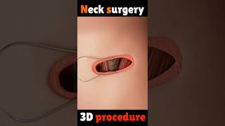 Neck surgery 3D animation video#shorts