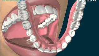 Protesi mobile totale: la dentiera inferiore