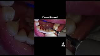 Dental plaque removal || Oddly satisfying video