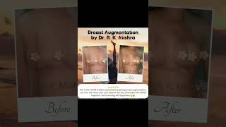 Breast Augmentation Implants in Lucknow | Breasts Implants Surgery