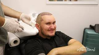 Andrew's Hair Transplant Journey in Turkey I Clinic International