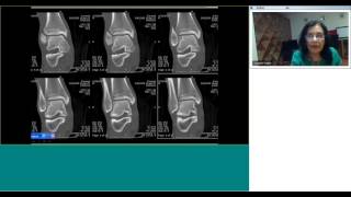 MRI of the Ankle by Dr.Sumathi Wable