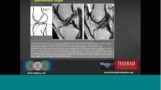 MRI appearence of traumatic & non traumatic lesions of anterior cruciate ligament by Dr Srikanth