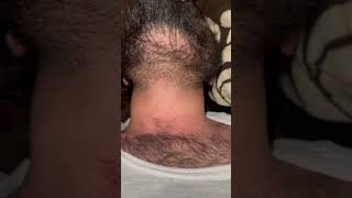 #ytshortsvideo #hair #barbersurgion #skincare #hairsalon #hairstyle #skin #beard #hairremoval