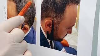 Hair Transplant procedure