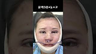 울퉁불퉁 각진 얼굴에서 둥글둥글 둥근 얼굴로 #plasticsurgeryinkorea