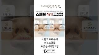 [성형전후] 휜코 매부리 무보형물 콧볼비대칭교정 #shorts