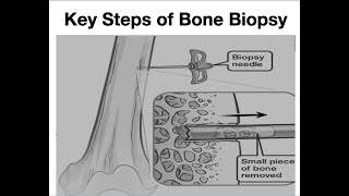 Bone Biopsy