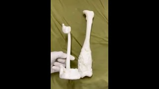 Distal Femur tumor or Osteosarcoma Surgery with 3 D Printing & Cryosurgery or Liquid Nitrogen