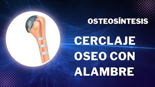 Osteosíntesis - Cerclaje oseo con alambre