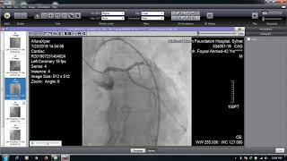 #Coronary Angiography #