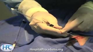 Radial Arterial Line Video