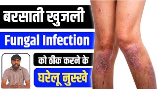 बरसाती खाज - खुजली Fungal Infection को ठीक करने के लिए घरेलू नुस्खे ✌️