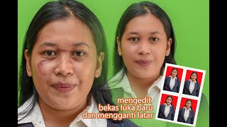 mengedit bekas luka  baru dan mengganti latar.   scar and acne  removal with photoshop