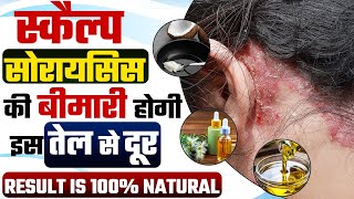 Best Oils For Scalp | कौन सा तेल Scalp Psoriasis को 100% जड़ से ठीक कर सकता है ?