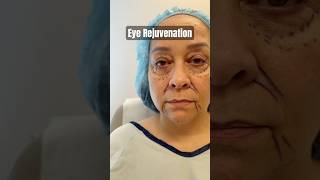 Blepharoplasty Changes Her Whole Face - She Looks 15 Years Younger! 😱 #facialplasticsurgery