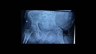 Pelvic Bone tumor surgery : Hemipelvectomy Surgery