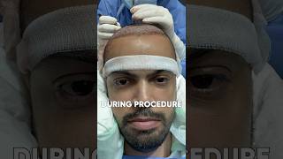 HAIR TRANSPLANT AFTER 6 MONTHS | HAIR TRANSPLANT RESULT