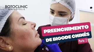 PREENCHIMENTO DE BIGODE CHINÊS COM ÁCIDO HIALURÔNICO | PARTE 2 | BOTOCLINIC TERESÓPOLIS