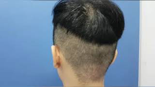 One week post Dr Harold Ma FUE hair transplant