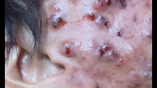 OH MY GOD! BIGGEST BLACKHEAD EVER SEE