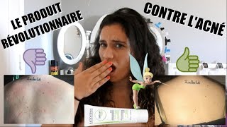 SOLUTION POUR SE DÉBARRASSER DE SES BOUTONS D'ACNÉ!!