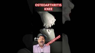 Osteoarthritis knee