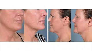 Kybella - Non Surgical Double Chin Treatment