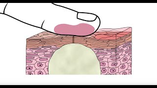 Using glycolic acid to help clear acne - Acne.org