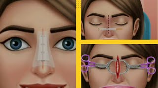 Nose Surgery Animation (Nose Job) #asmr