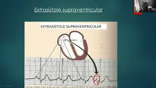 Fisiopatología de las arritmias  Dr  Julio Suva