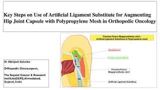 Neo Capsule by Artificial Ligament Substitute and Polyprolene Mesh in  Proximal Femur Tumor Surgery