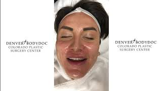 PRP Microneedling - Vampire Facial Demonstration