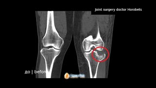 Лікування перелому колінного суглобу | knee fracture treatment