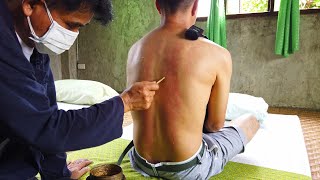 ASMR | Back SKIN SCRAPING Gua Sha Massage Treatment for CHRONIC BACK PAIN in Chiang Mai, Thailand