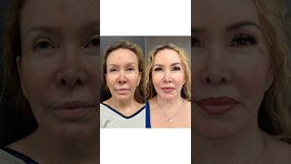 BEAUTIFUL FACELIFT TRANSFORMATION #faceliftsurgery #plasticsurgery